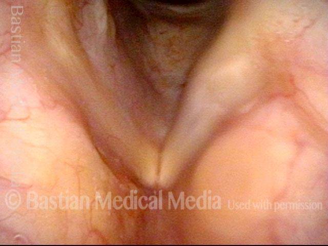 Right vocal cord paresis