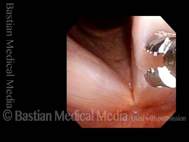 2-millimeter forceps being used to scrape the area of leukoplakia