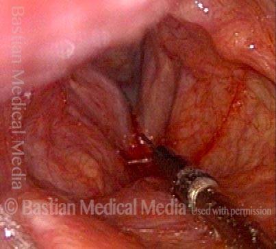 injection of right vocal cord with voice gel