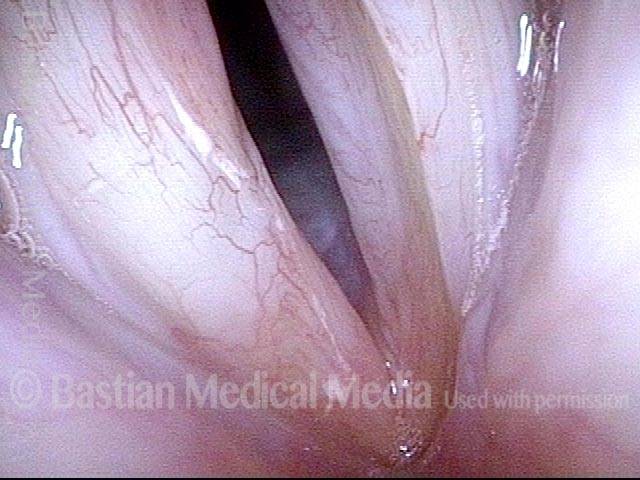 Vocal cord cancer