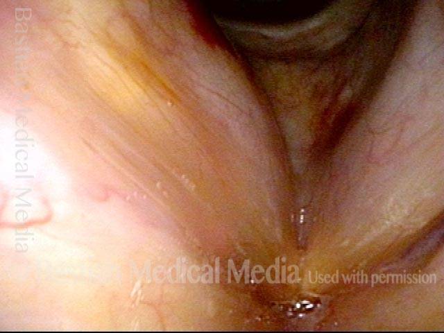 plumping up of the right vocal cord with voice gel.