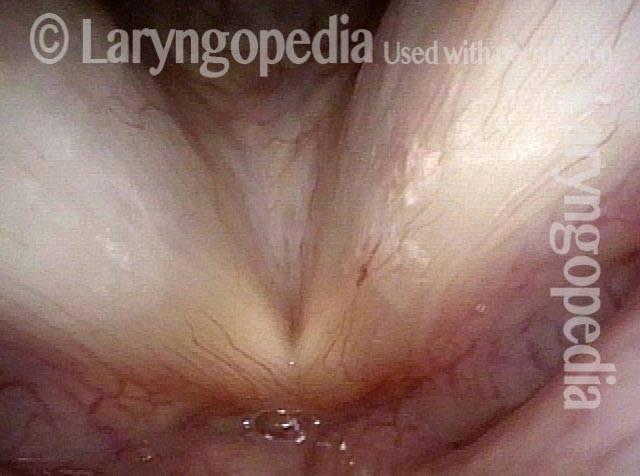 ectatic capillary of the left vocal cord