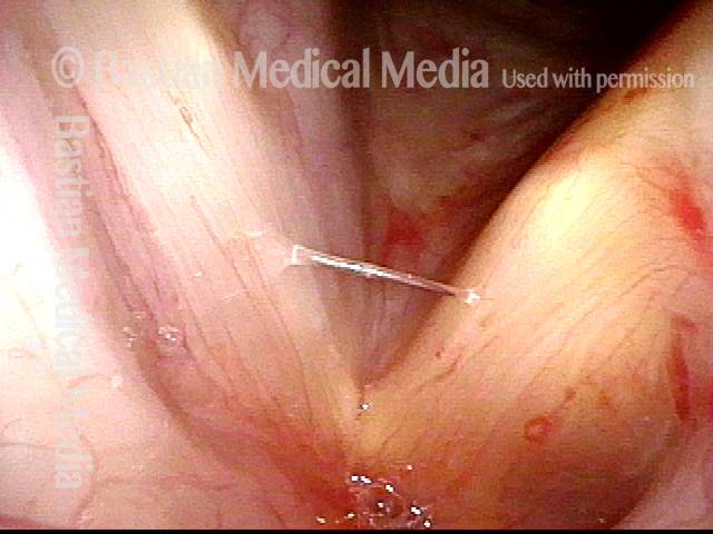 placement of an implant into the left cord