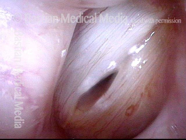 Paresis, TA-only: after implant is placed