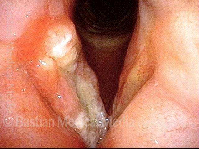 persistent right vocal cord cancer