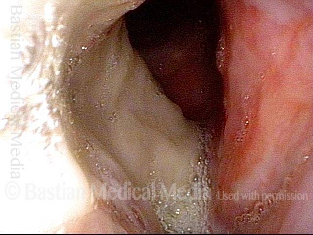 Right vocal cord One week after aggressive cordectomy