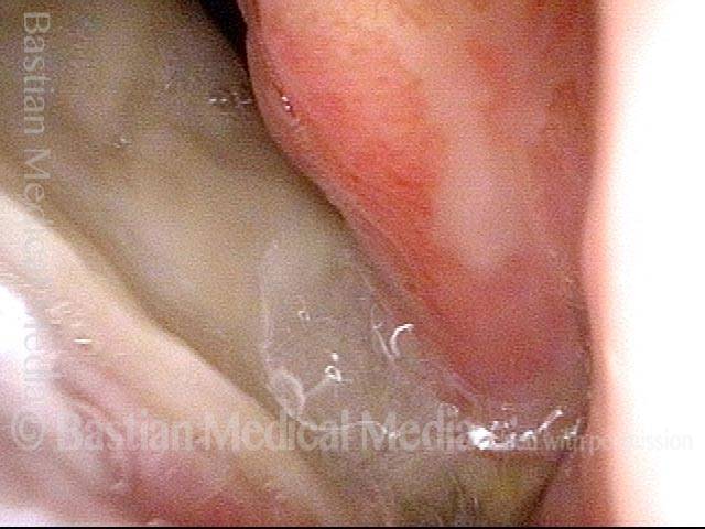 left vocal cord now has no partner against which to vibrate