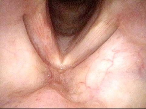 inflamed vocal cord
