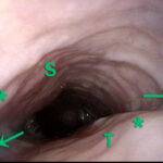 Lateral dilation in the upper esophagus