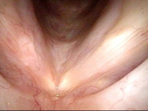 Close view of the vocal cords