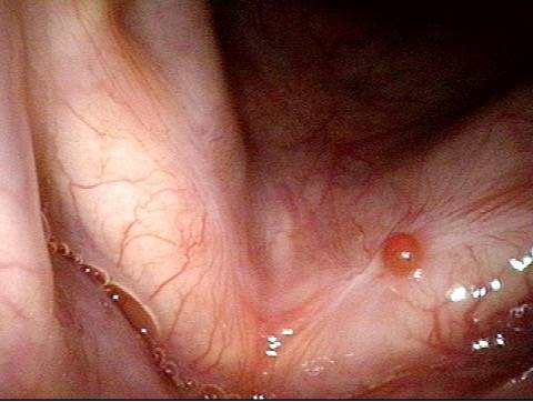 Granuloma on vocal cord