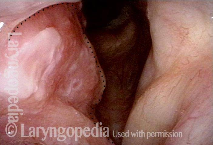 bulk of tumor involves the cartilaginous glottis