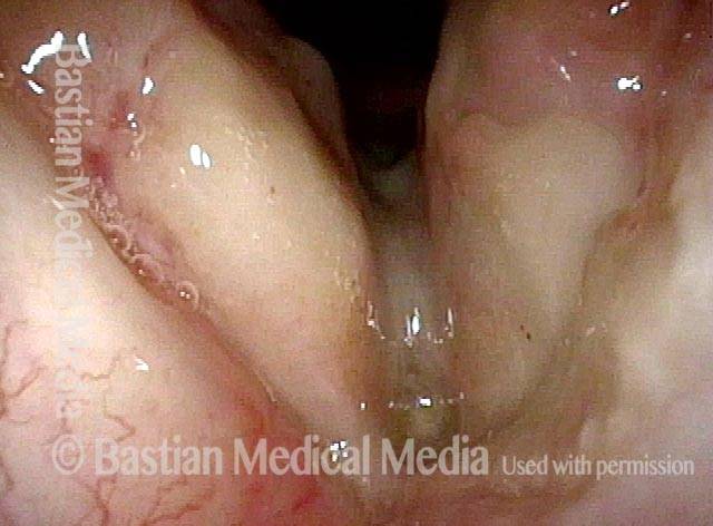inner perichondrium of the thyroid cartilage