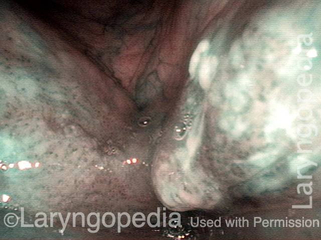 areas of leukoplakia and stippled vascularity