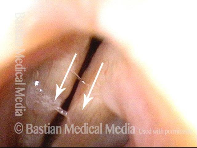 posterior commissure just before reaching contact for phonation