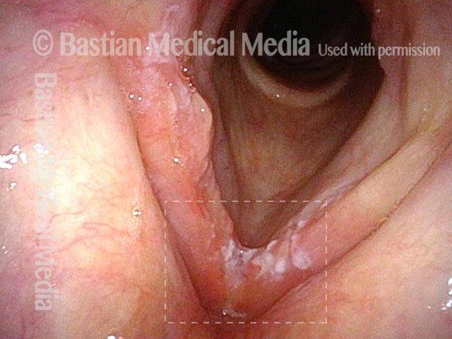 Superficial cancer involving both vocal cords