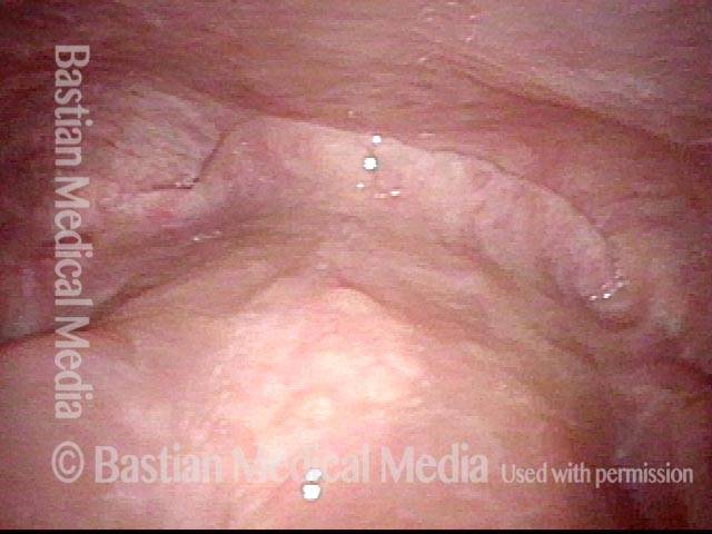 Vocal cord cancer