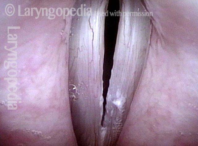 irregular margins and white lesions