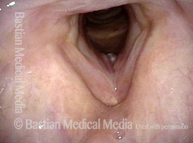 abnormality below the vocal cords