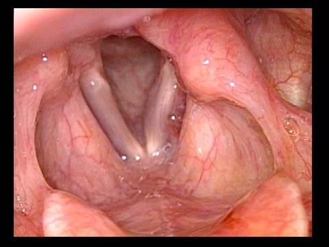 Voice gel injected into vocal cord