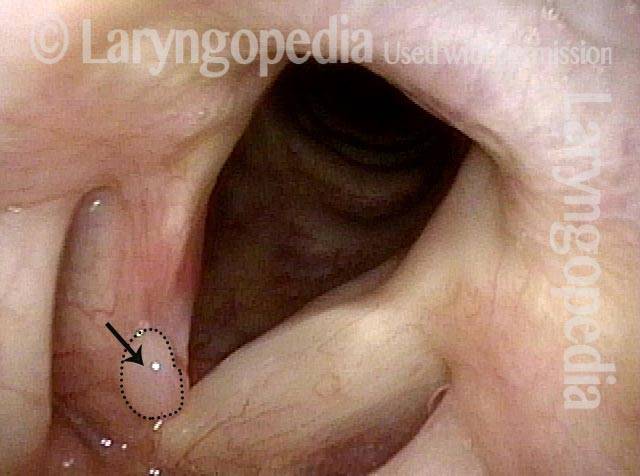 residual granuloma on the upper surface anteriorly