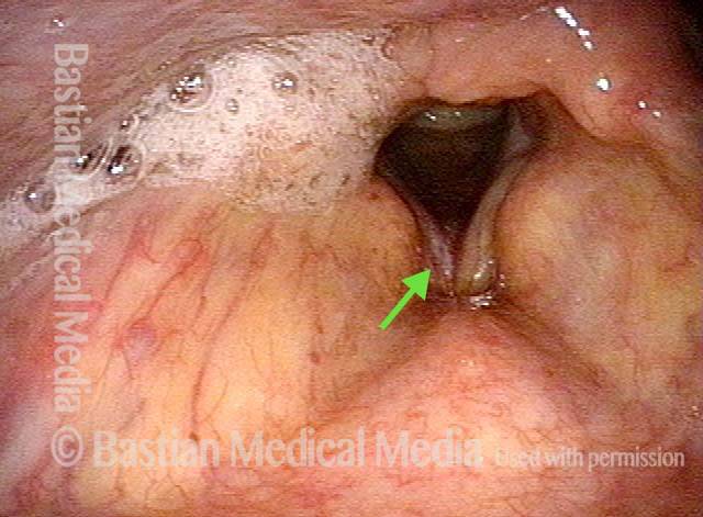 vocal cords of long term smoker