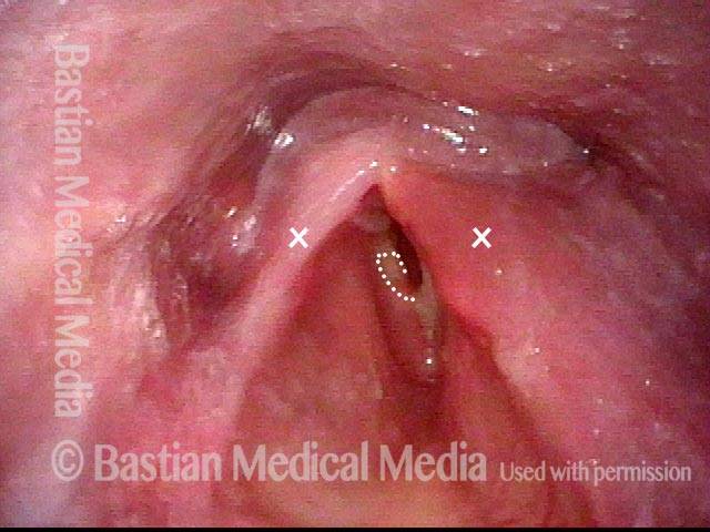 Marked laryngeal swelling