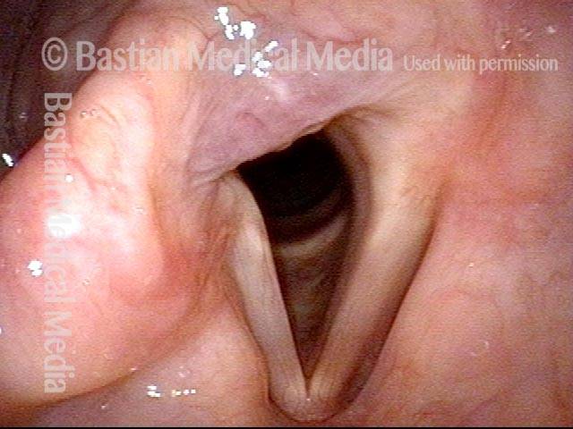 PCA muscle of the right vocal cord is not working