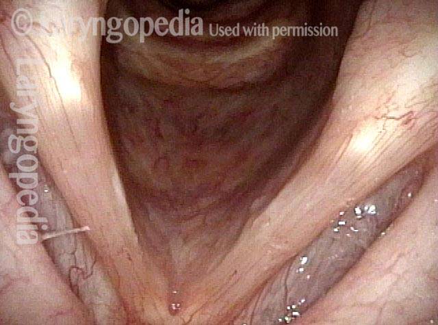 bducted vocal cords