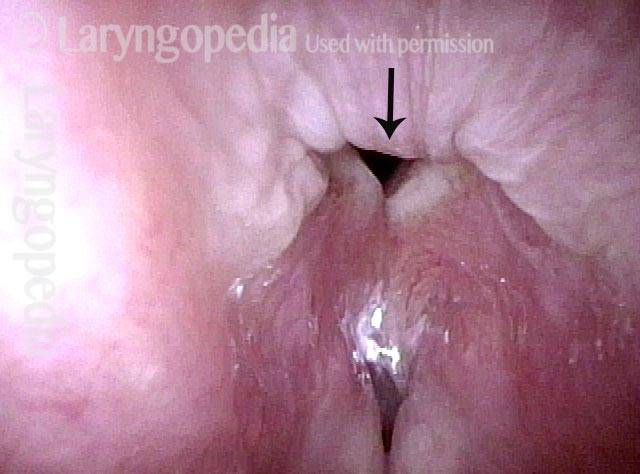 interarytenoid mucosa has oscillated anteriorly