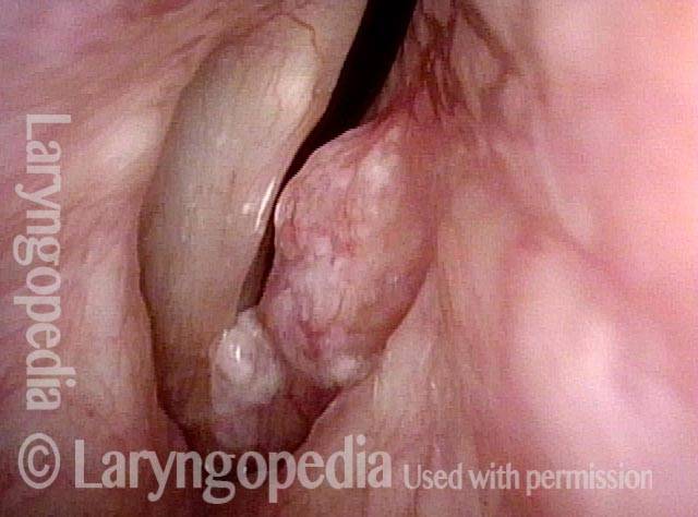eft vocal cord lesion