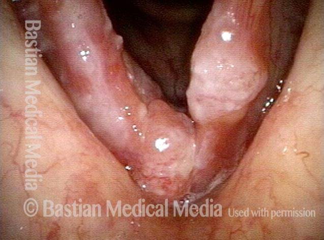 Bilateral vocal cord cancer