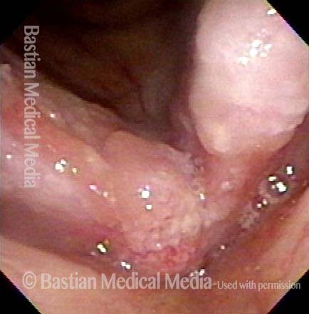diffusely abnormal-looking tissue on his vocal cords