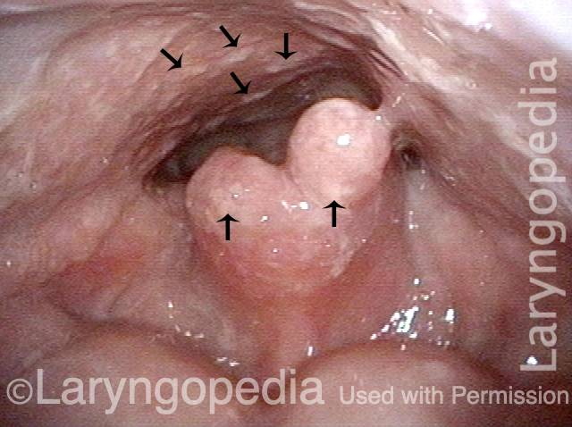 white lesions on residual epiglottis and posterior pharyngeal wall