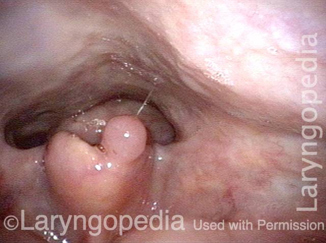 white residue on esophageal remnant and posterior pharyngeal wall is gone
