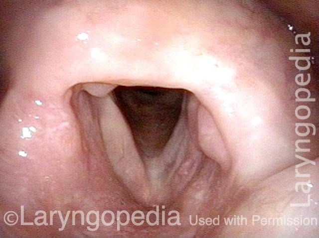 inside the laryngeal vestibule