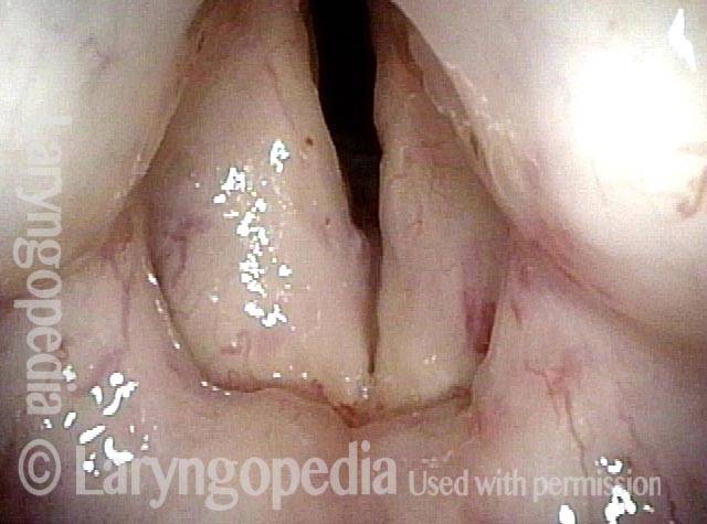 forty years after curative radiation for a vocal cord cancer