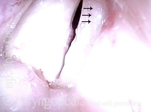 vibrating mucosa in open phase