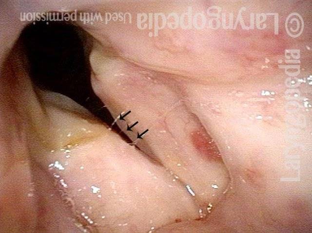 posterior vocal cord divots