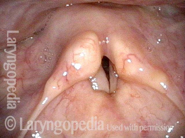Vocal cords Three months post-surgery