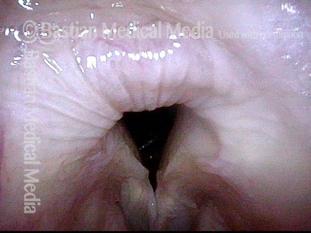 no abnormality of the cricoid or arytenoids