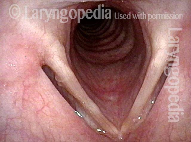 hitish lesion of the right cord is a red herring finding