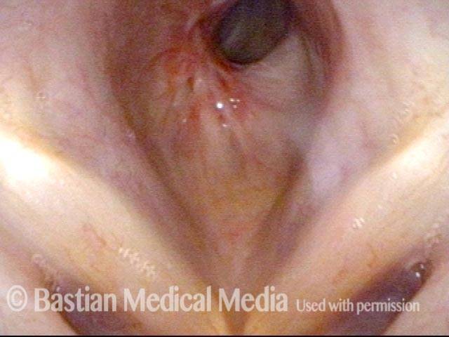 Subglottic / Tracheal stenosis
