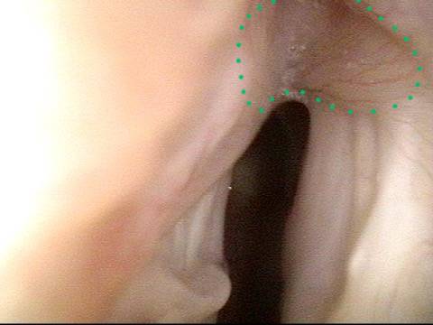 posterior commissure scarring