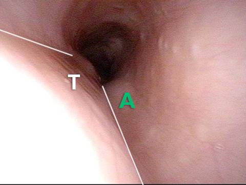 posterior wall of the trachea