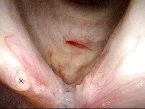 anterior vocal cords have not yet re-mucosalized