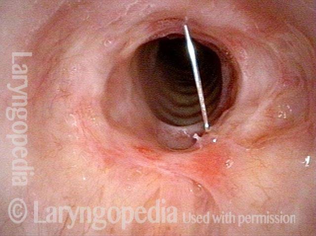 Needle going into the posterior of stenosis