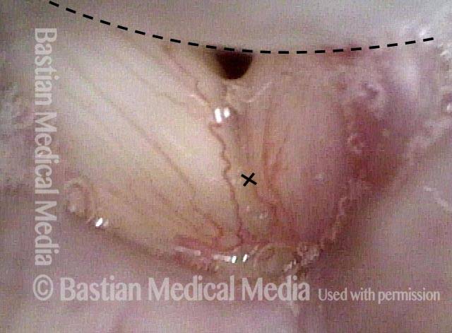 anterior edge of the granuloma
