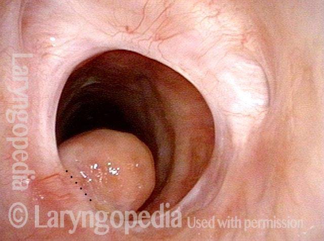 inhalation draws the granuloma below the suture line