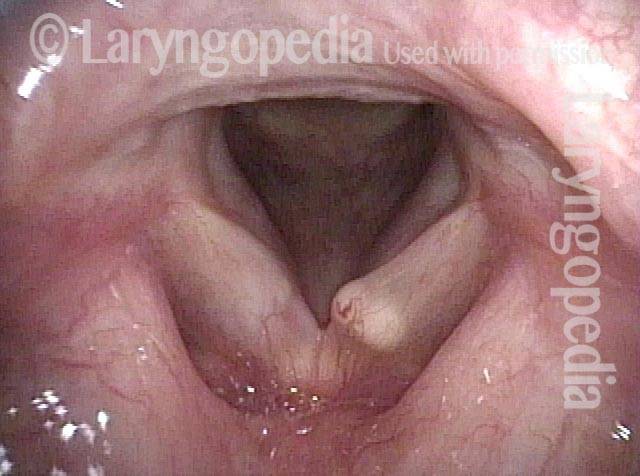 white submucosal mass on left vocal cord